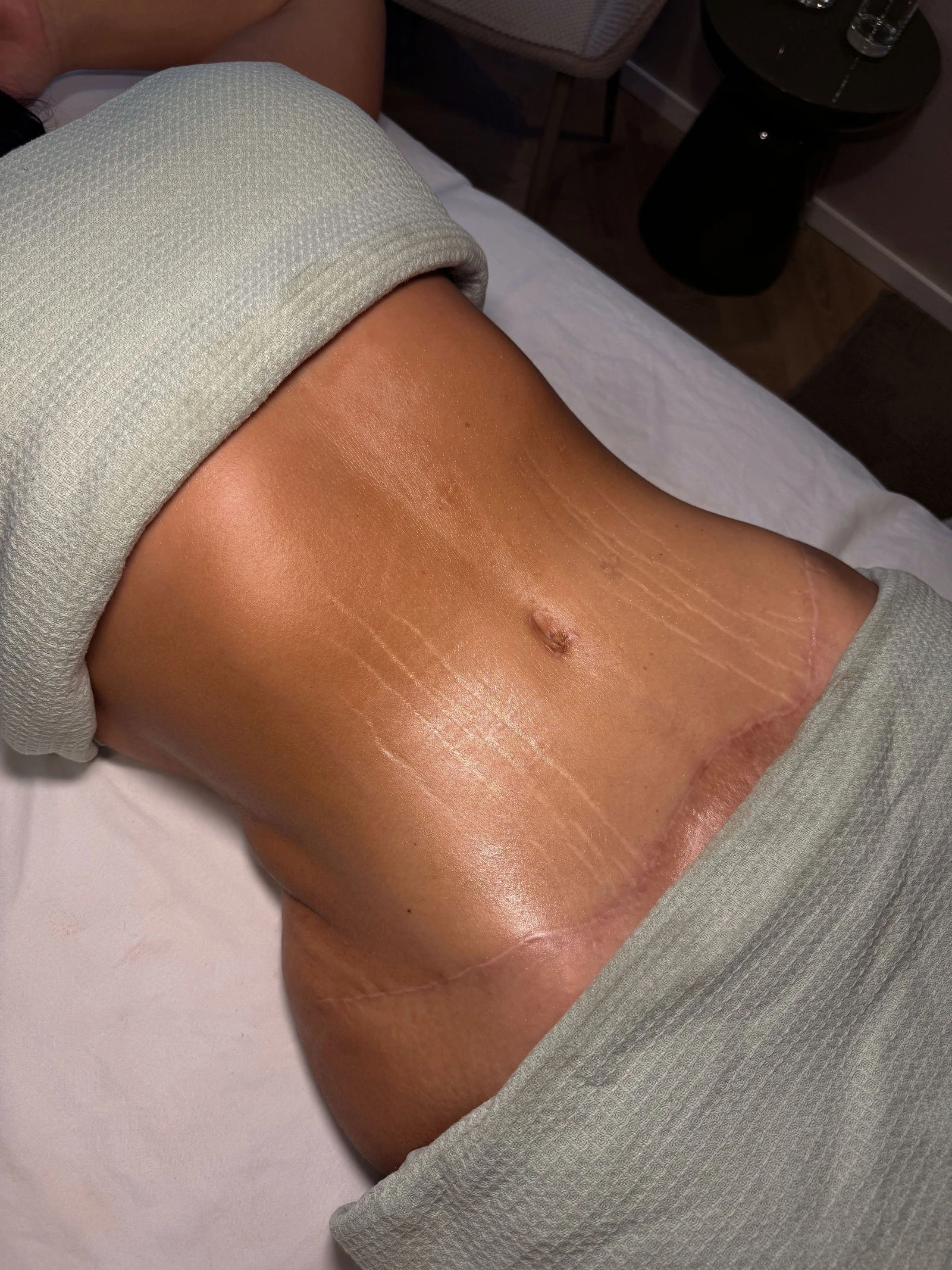 Stomach on the treatment couch: post-operative care at LoriSkin